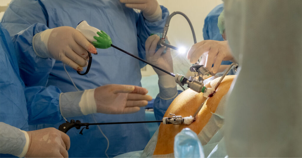 متى تحتاج لإجراء عملية الفتق؟