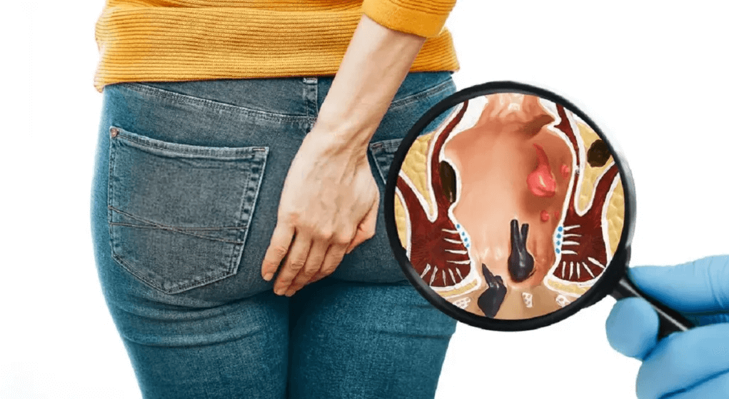 أفضل النصائح لعلاج البواسير